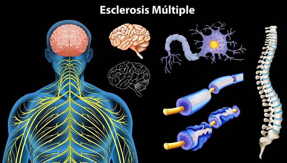 Esclerosis multiple complejidad