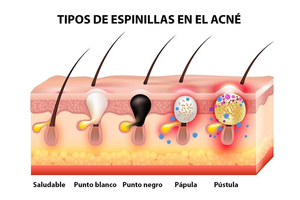 CBD para el acné
